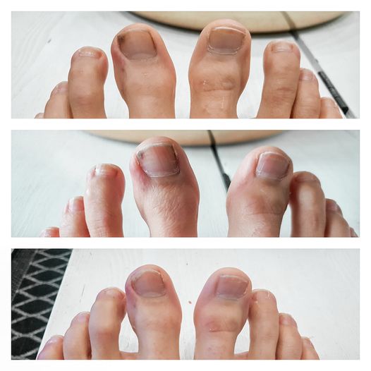 nail kokemuksia