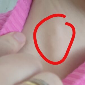 Onko sinulla syntymämerkki?